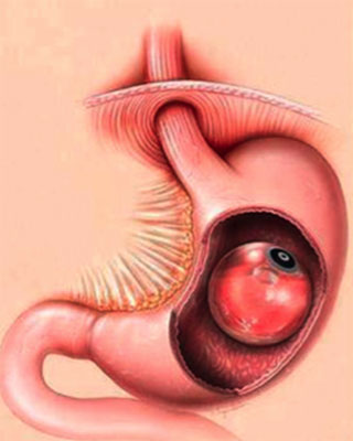 Tratamento de obesidade