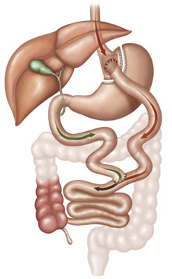 Gastrectomia Vertical (ou Sleeve Gastrectomy)